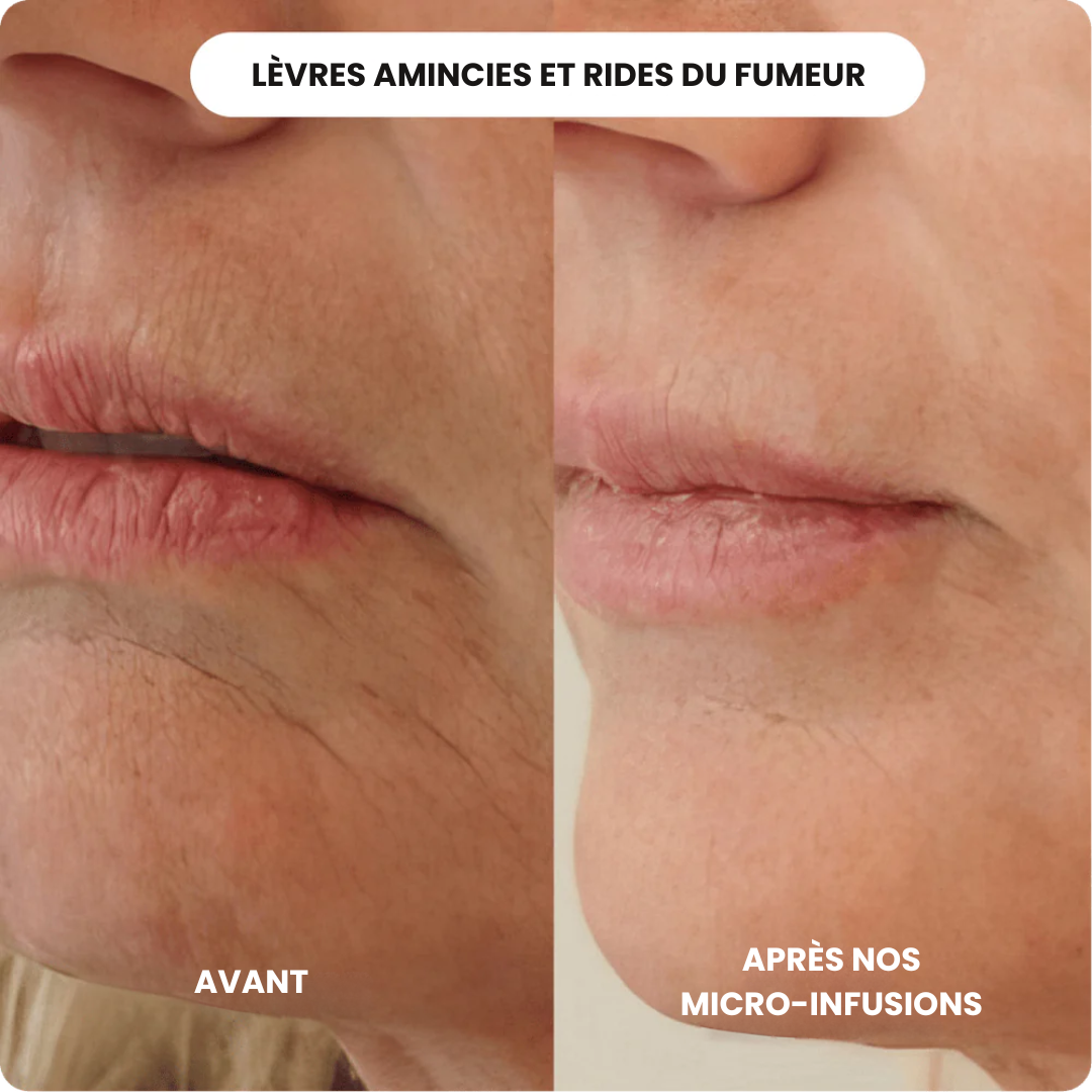 Micro Infusion Anti Âge