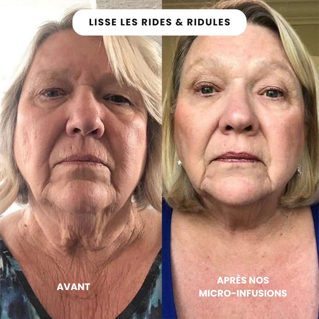 Micro Infusion Anti Âge
